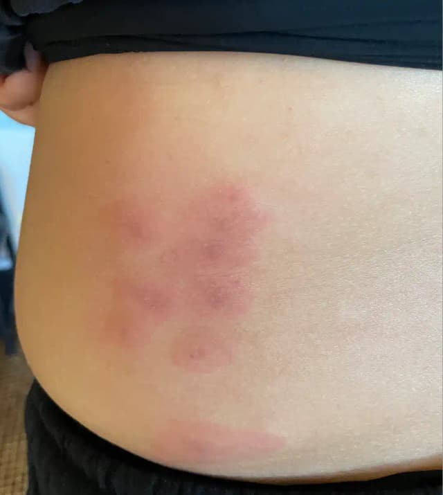 Piqûres de punaises de lit en grappe sur le dos