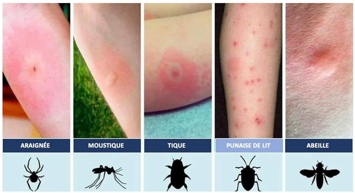 exemple visuel de piqures de punaises de lit sur le dos