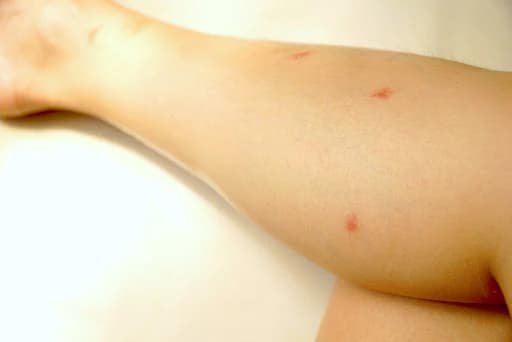Piqûre de puce : boutons rouges isolés ou en petits groupes sur les jambes