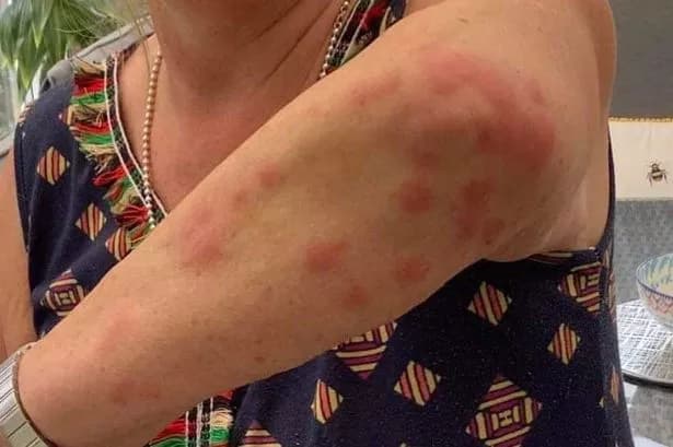 exemple visuel de piqures de punaises de lit sur le dos