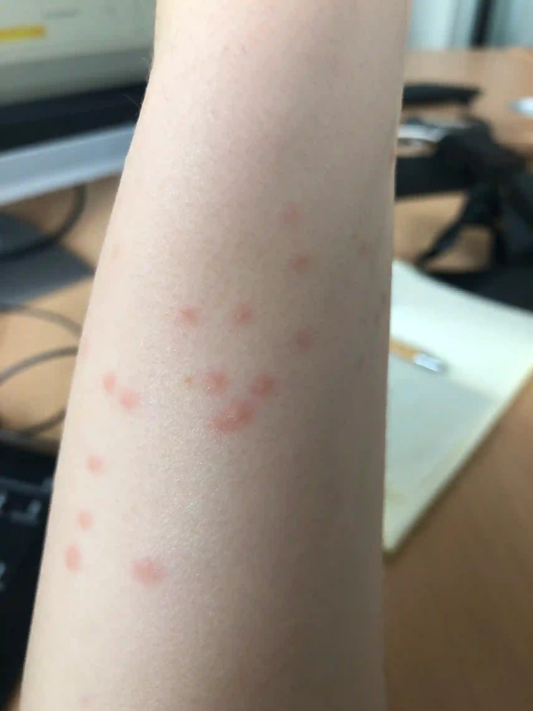 Piqûre de punaise de lit : boutons regroupés ou alignés par 3 ou 4