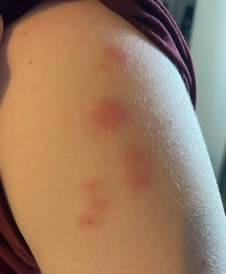 Piqûres de punaises de lit alignées sur le bras