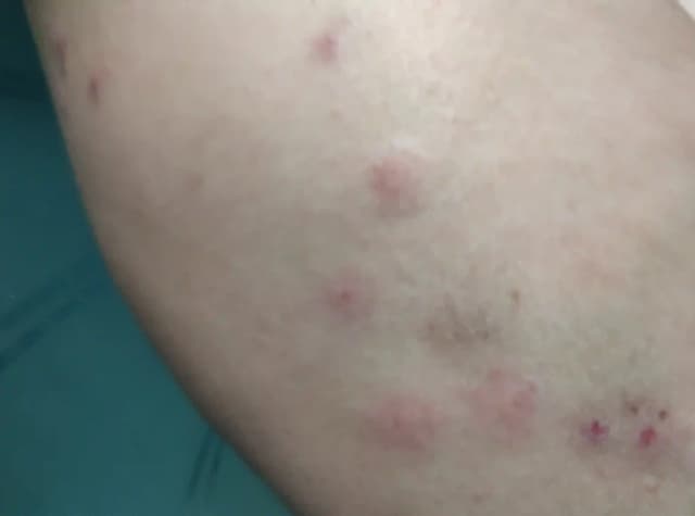 Piqûres groupées de punaises de lit sur la jambe