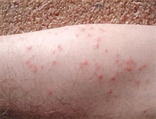exemple visuel de piqures de punaises de lit sur le bras